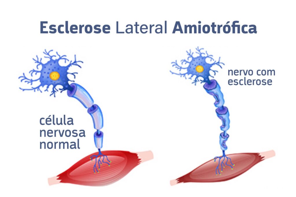 Esclerose Lateral Amiotrófica celula nervosa normal e danificada