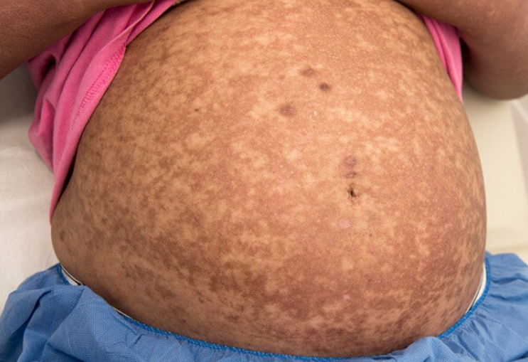 Grávida com lupus