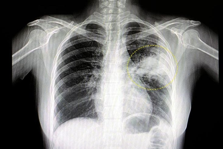 pneumonia viral
pneumonia bacteriana
pneumonia atipica
desvendando a cura